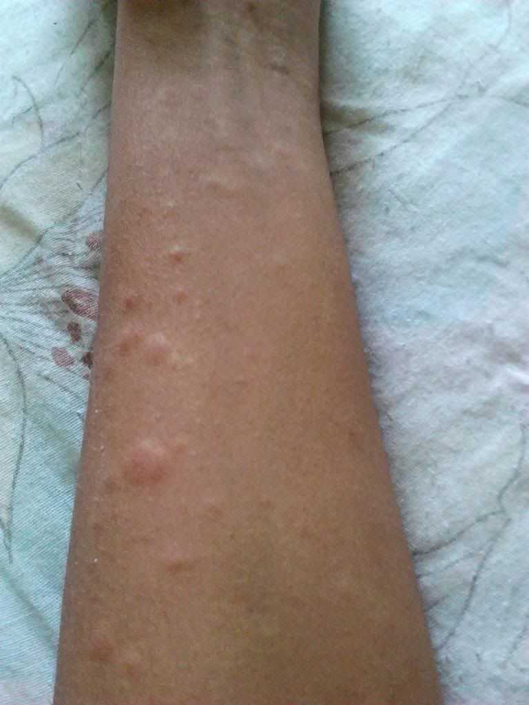 Is this an allergy to my body wash (pictures)? Yahoo Answers